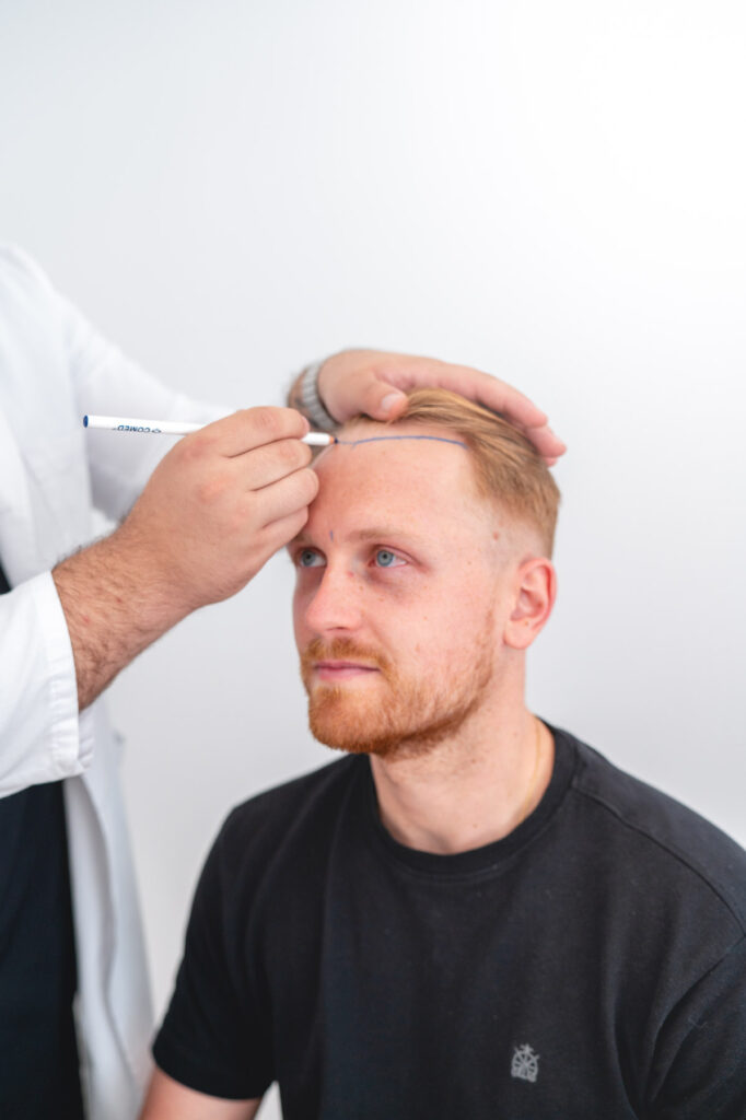 Medidas del Crecimiento Capilar Esperado para Cirugía Capilar Clínica KBO Roquetas de Mar